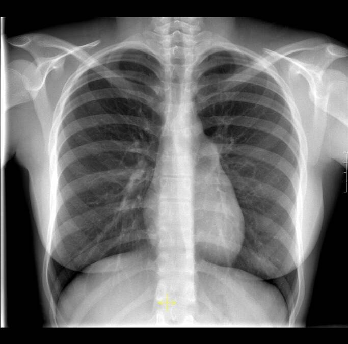 Ref: TOUK20160810001 – Nuevo dispositivo portátil de radiografía para descartar enfermedades cardíacas de forma rápida y precisa en pacientes con dolor torácico