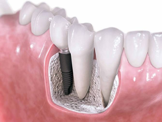 Ref: TRRO20160728001 Desarrollo de nuevos biomateriales metálicos para aplicaciones dentales